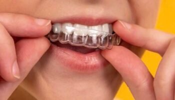 3 Quick Top Tips For Taking Care Of Your Invisalign Aligners