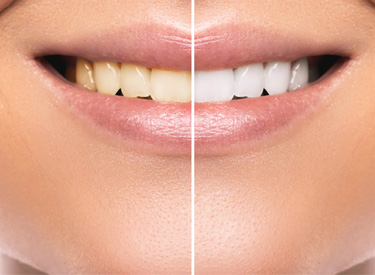 tooth whitening