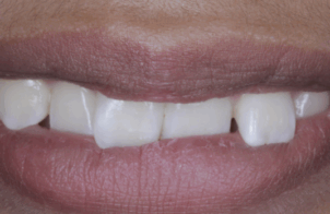 Before close up mouth