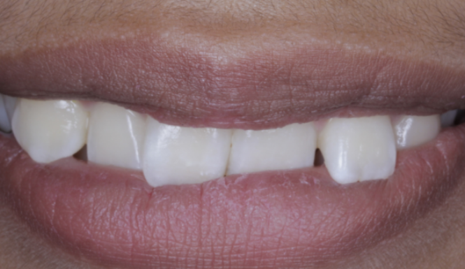 Before close up mouth