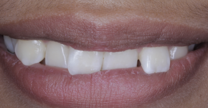 Before close up mouth