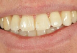 After - Alexandra Dental