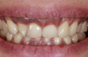 Before close up mouth