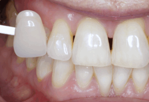 After - Alexandra Dental