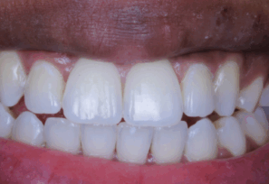 After - Alexandra Dental