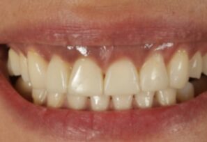 After - Alexandra Dental