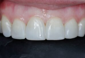 After - Alexandra Dental