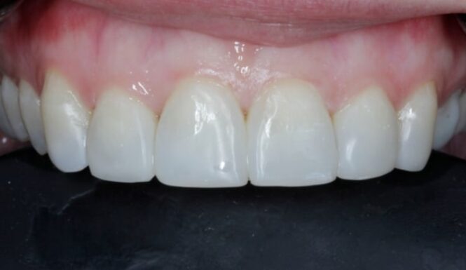 After - Alexandra Dental