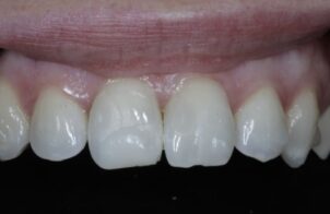 Before - Alexandra Dental