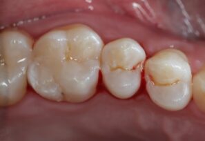 After - Alexandra Dental