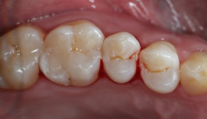 After - Alexandra Dental