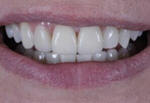 After - Alexandra Dental