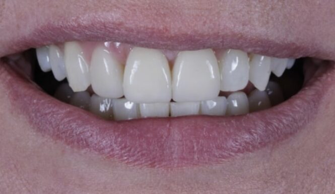 After - Alexandra Dental
