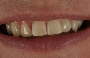 Before - Alexandra Dental
